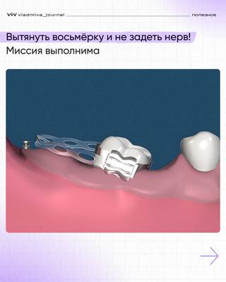 Ортодонтическое вытяжение вместо сложного удаления.